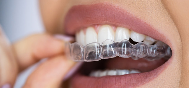 Ortodoncia invisible
